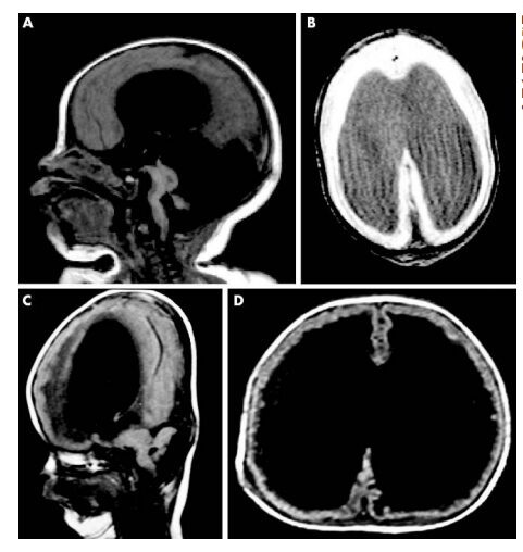 Risonanza magnetica di due pazienti affetti dalla WWS nati da due giorni (A e B) e da sedici mesi (C e D). Entrambe le tipologie di pazienti mostrano idrocefalo, dilatazione ventricolare, agiria, ipoplasia cerebellare e assenza del corpo calloso
