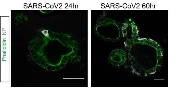 Colorazione a immunofluorescenza di organoidi intestinali infettati da SARS-CoV-2