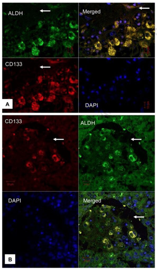 Figura 3- cellule CD133+/ALDH+ di HCC sono state localizzate nelle aree adiacenti il tessuto connettivo o all’interno di un vaso (fonte Pubmed)