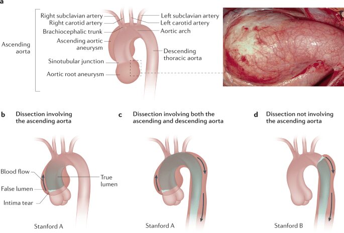 Dissecazione aortica nei pazienti affetti da sindrome di Marfan