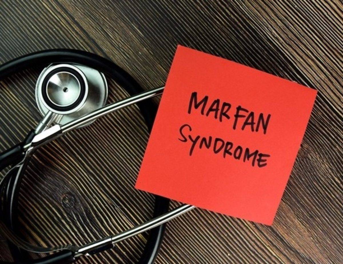 Sindrome di Marfan