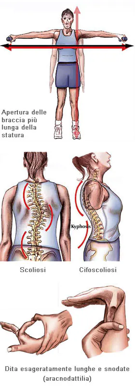Alcuni dei segni caratteristici della sindrome di Marfan a livello dell'apparato muscolo-scheletrico: lunghezza dell'apertura delle braccia superiore alla statura, scoliosi e cifoscoliosi, segno del pollice e segno del polso 