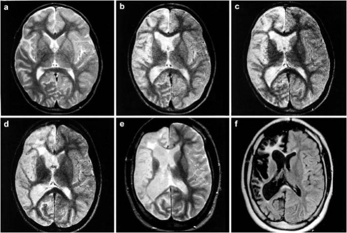 Risonanza Magnetica di un paziente con Sindrome di Rasmussen.