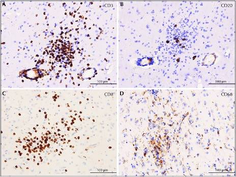 Analisi istologica al microscopio dei linfociti T in paziente con Sindrome di Rasmussen.