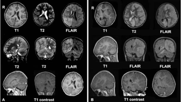 Risonanza Magnetica di un paziente con Sindrome di Rasmussen.