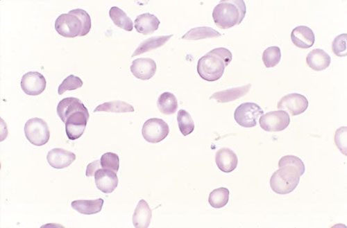 caratteristici globuli rossi a forma di falce nell'anemia falciforme