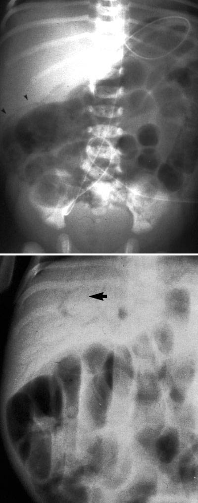 Caratteristiche radiologiche dell'enterocolite necrotizzante.