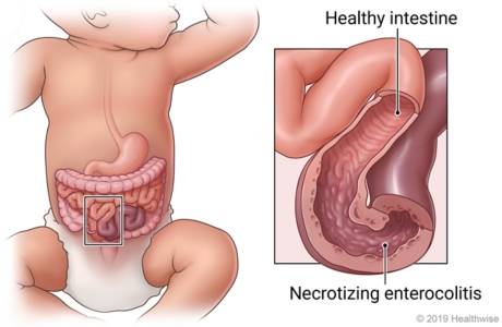 Rappresentazione grafica dell'intestino nell'enterocolite necrotizzante. 