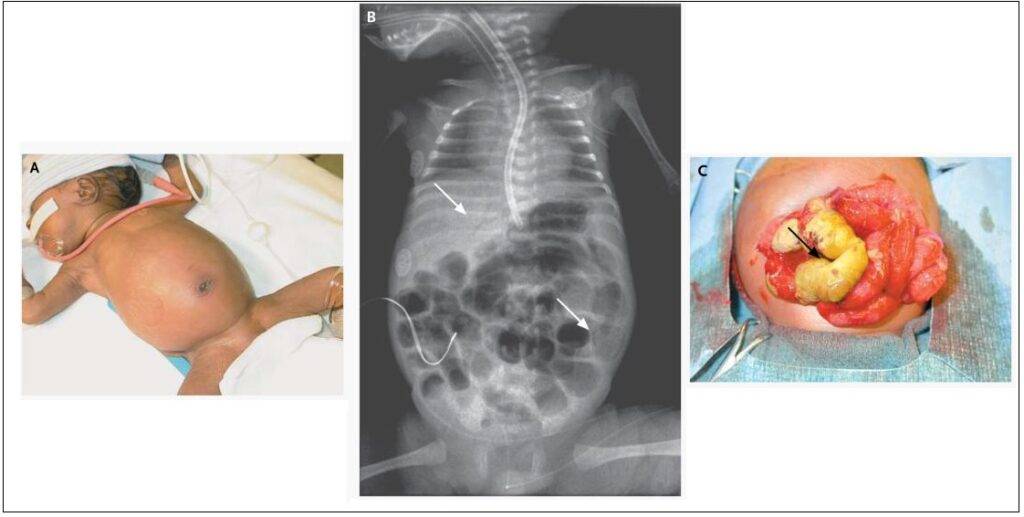 Caratteristiche cliniche e radiografiche dell'enterocolite necrotizzante.  