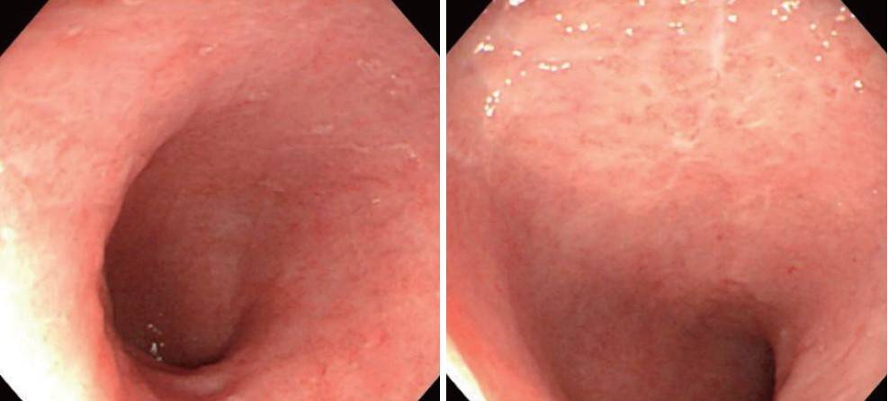 Figura 6 - Immagini endoscopiche dell’ileo distale dove si notato erosione della mucosa, riduzione dei villi ed essudato biancastro