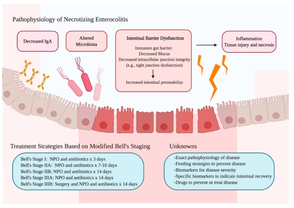 Riassunto della fisiopatologia, delle strategie terapeutiche e delle incognite dell'enterocolite necrotizzante. La fisiopatologia della NEC è sfaccettata e comprende disfunzione della barriera intestinale, diminuzione delle IgA e microbiota alterato. Le attuali strategie di trattamento includono l'interruzione dell'alimentazione con latte artificiale e l'inizio di antibiotici in base alla gravità della malattia, come classificato dalla stadiazione di Bell. Molto rimane sconosciuto sulla prevenzione, la diagnosi e il trattamento delle malattie. 