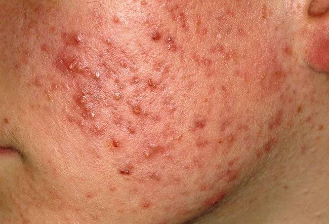 Acne vulgaris causata da Cutibacterium acnes