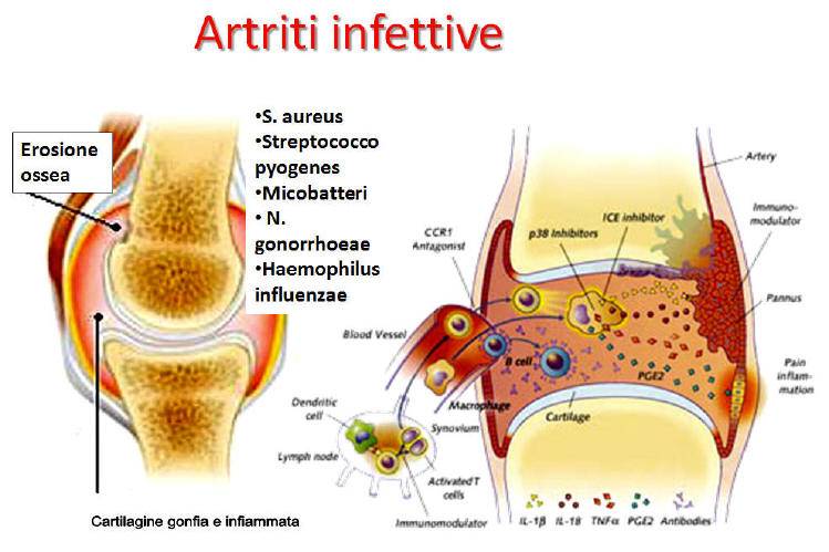 Lesioni dovute a artrite settica