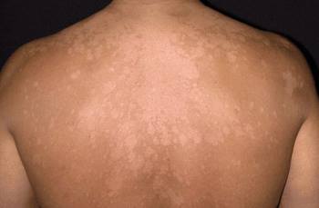 chiazze chiare caratteristiche della pitiriasi versicolor, una micosi da piscina abbastanza frequente - micosi piscina