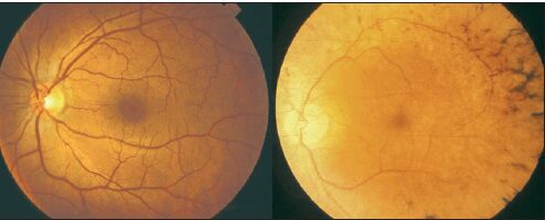 Figure 4-Fundi of a healthy individual and a patient with retinitis pigmentosa [pubmed.ncbi.nlm.nih.gov]