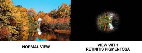 Figure 3-View in comparison between a healthy eye and an eye with retinitis pigmentosa [glance24.com]
