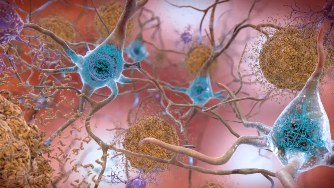 Rappresentazione grafica della formazione di placche beta-amiloidi esternamente (in marrone) e grovigli neurofibrillari (in blu) all'interno dei neuroni.