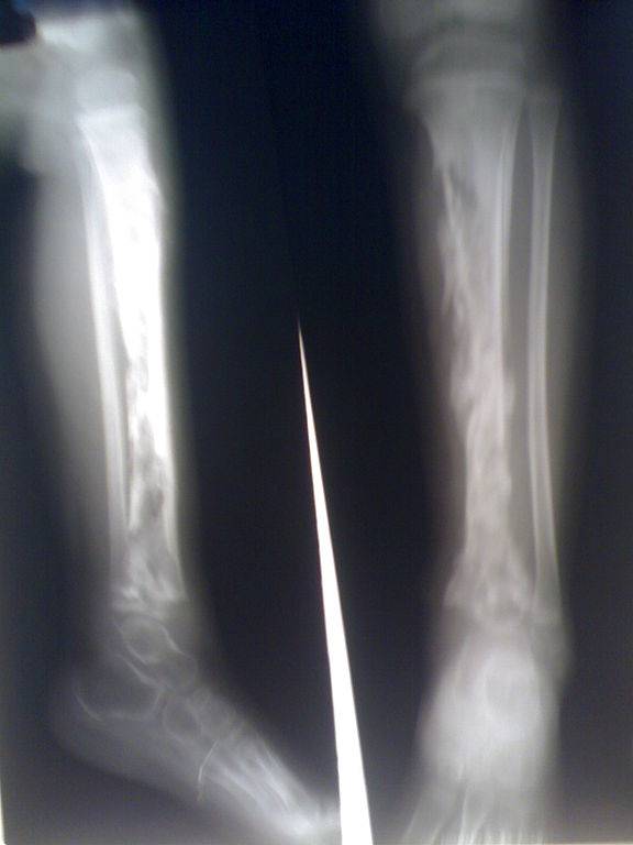 Radiografia tibia con osteomielite