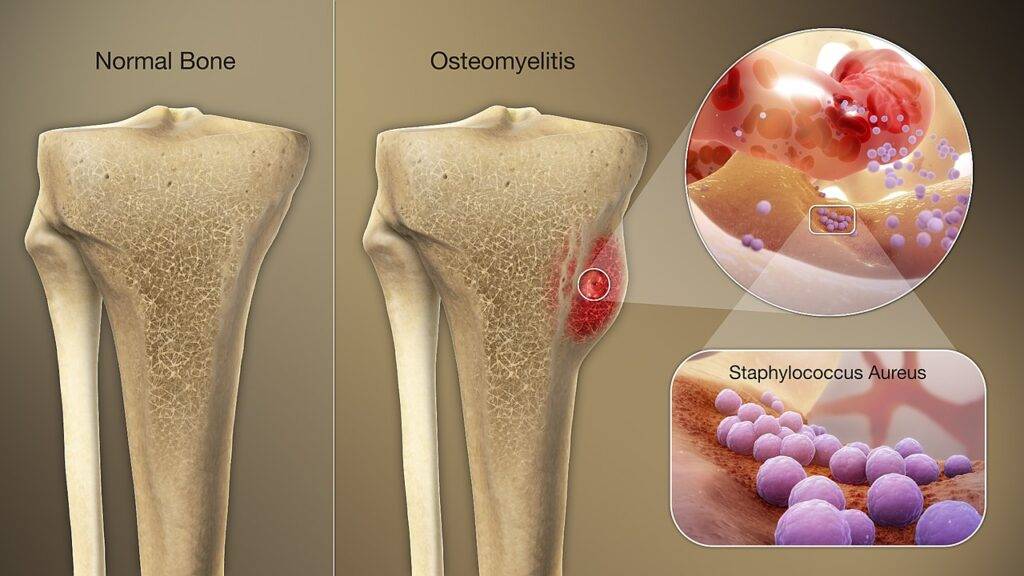 Infezione ossea da S.aureus