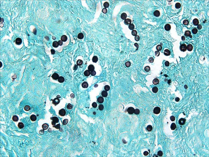 Osservazione al microscopio di colonie di Lacazia loboi