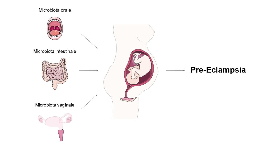 Visualizzazione schematica del possibile effetto del microbiota materno orale, intestinale e vaginale nello sviluppo della preeclampsia