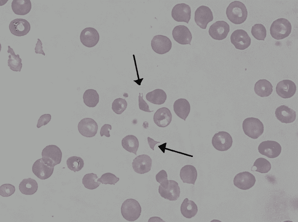 Le frecce indicano i frammenti di globuli rossi presenti in un soggetto con la sindrome emolitico-uremica