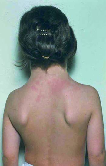 Ragazza affetta da sindrome di Turner
