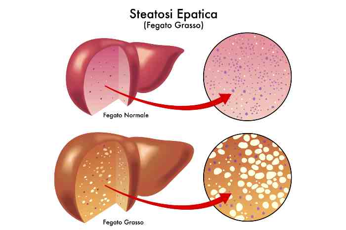 Differenze tra un fegato normale ed un fegato grasso