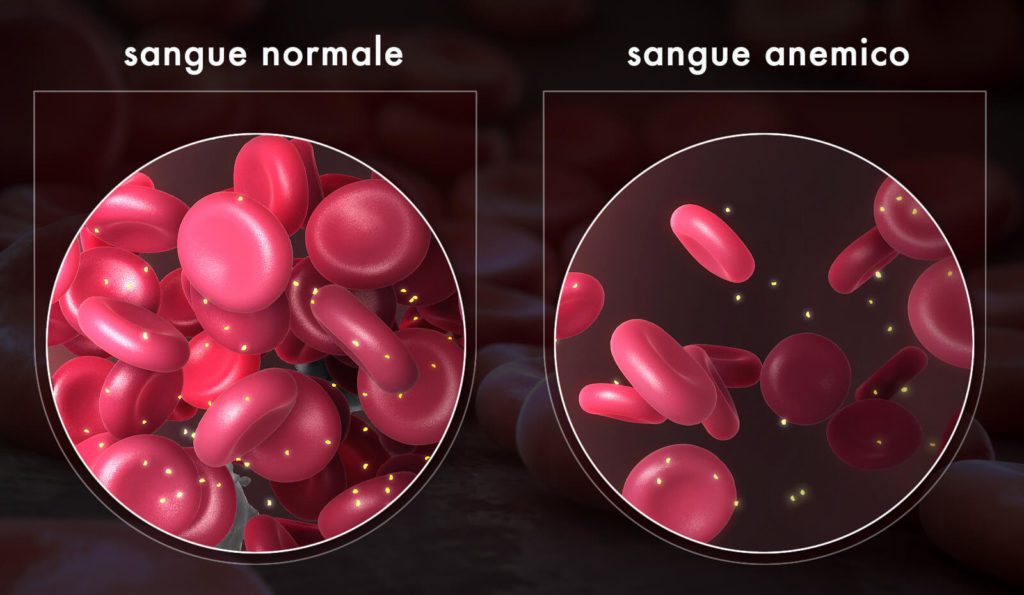Anemia sideropenica