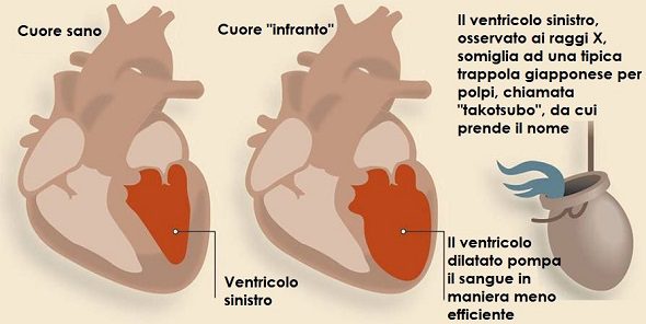 Alterazioni morfologiche del ventricolo sinistro