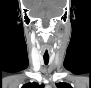 TC coronale con contrasto del collo che dimostra un ascesso di 3,3 cm nel triangolo posteriore sinistro con adenite cervicale adiacente e occlusione della vena giugulare interna sinistra di un soggetto affetto da sindrome di Lamierre
