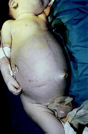 Bambino di un mese con distensione addominale pericolosa per la vita a causa di un massiccio coinvolgimento del fegato. 