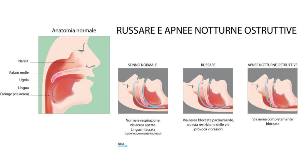 Figura 1 - Russare durante il sonno ed apnee notturne