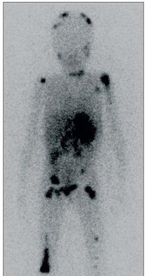 La betaiodobenzylguanidina (MIBG) mette in evidenza le sedi multiple del neuroblastoma, incluso il tessuto osseo e il tessuto sottocutaneo