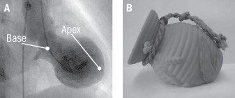 Radiografia del cuore ed immagine del takotsubo
