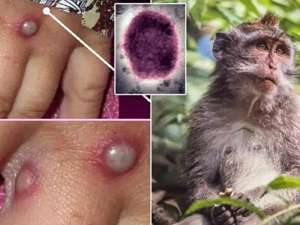 Mpox Europa