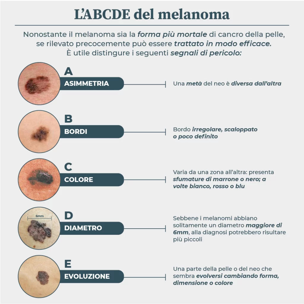 Infografica molto utile su come riconoscere i Nei sospetti