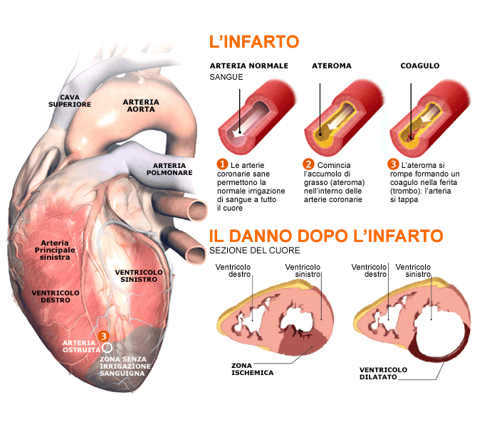 Il cuore dopo l'infarto