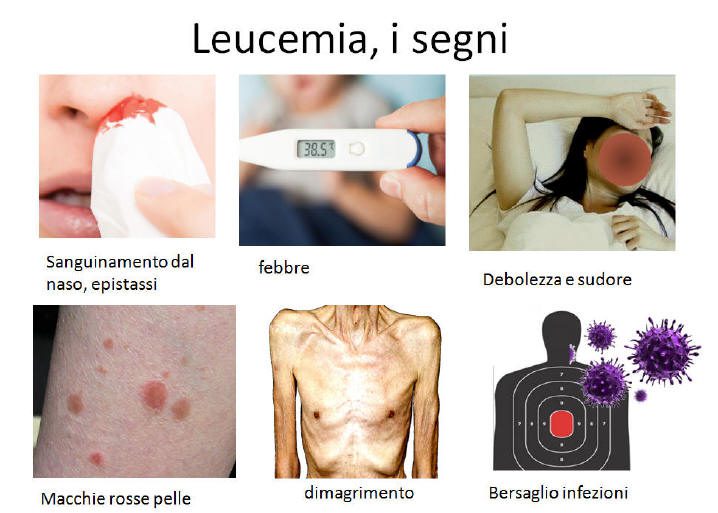 Sintomi della leucemia