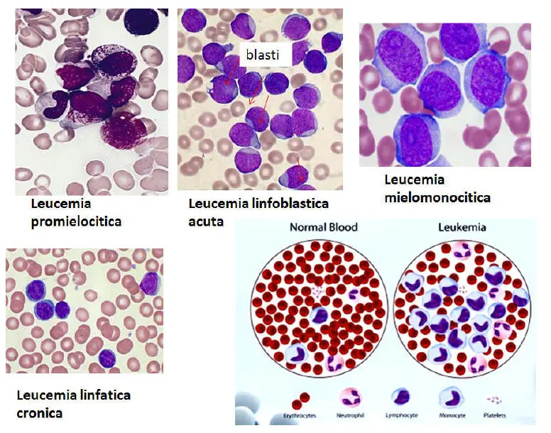varie tipologie di leucemia