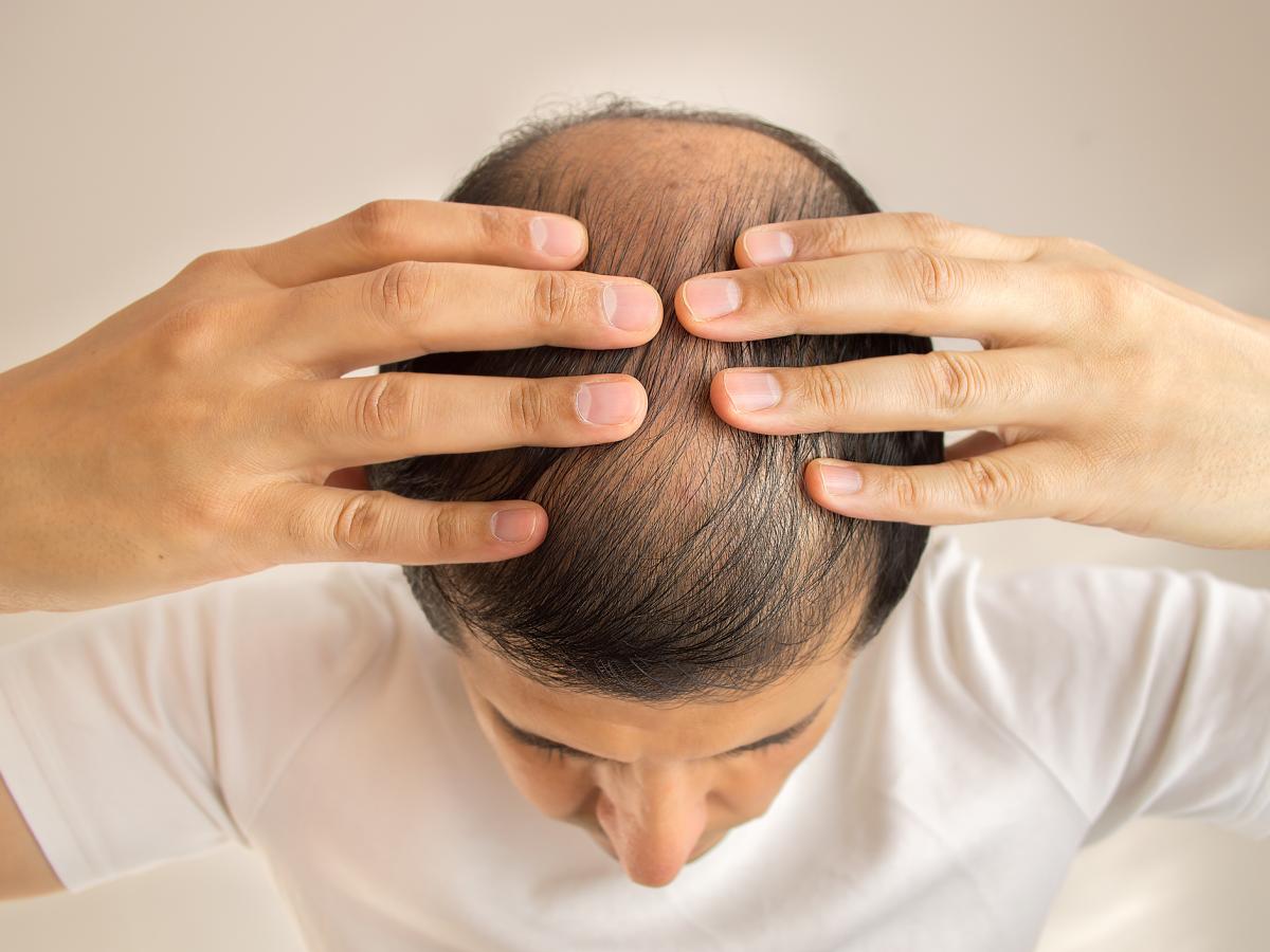 perdita dei capelli