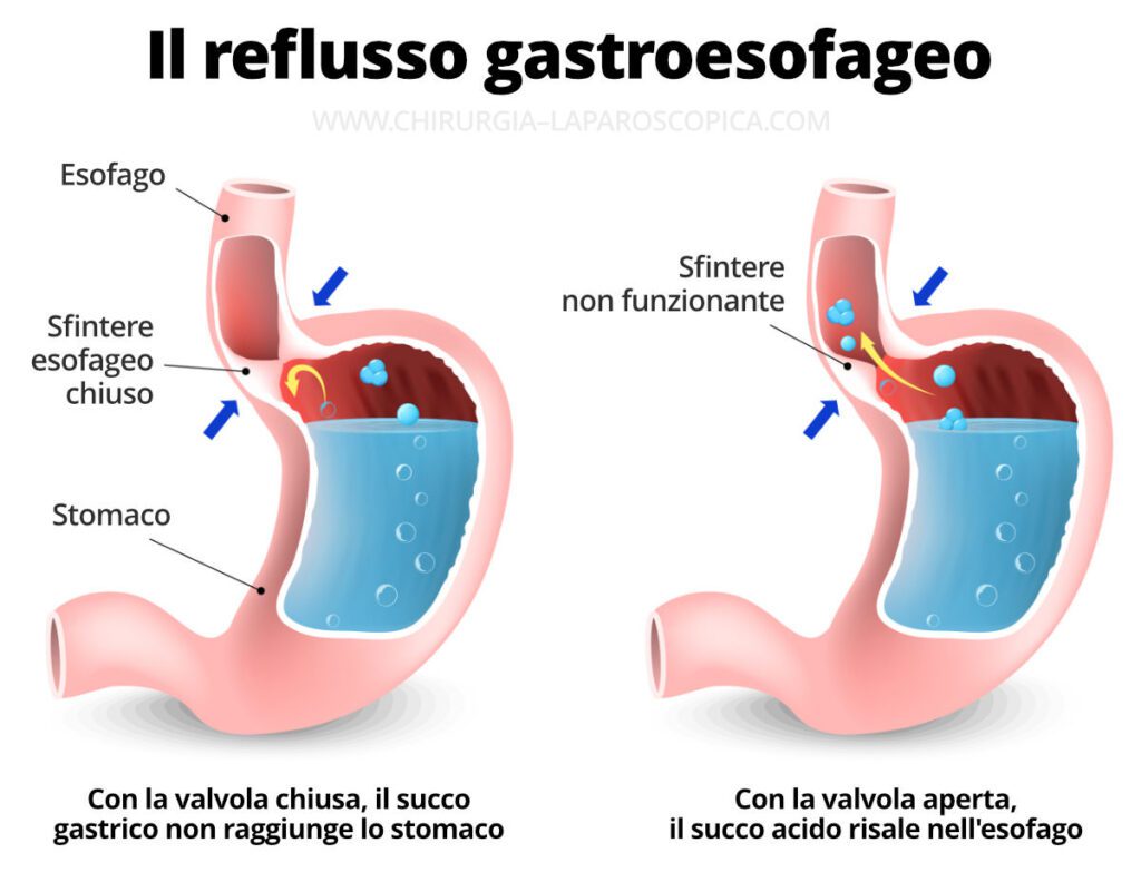 In this image you can see how gastric reflux works