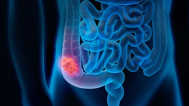 Cancro del colon-retto giovani adulti
