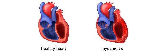 Differenza tra un cuore sano e un cuore affetto da miocardite. La miocardite è in aumento tra i neonati del regno unito