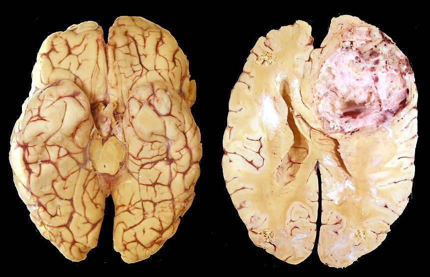 Glioblastoma cerebrale