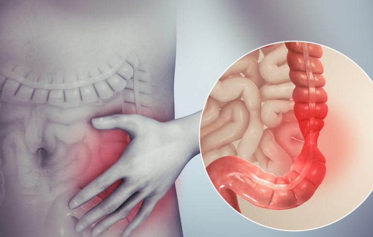 Sindrome dell'intestino irritabile sintomi