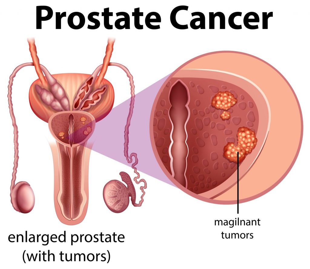 correlazione tra infiammazione e tumore alla prostata