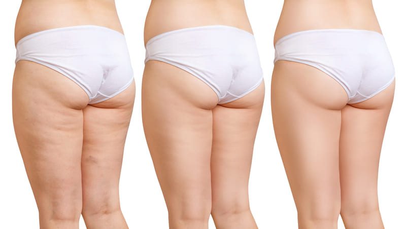 Come sconfiggere la cellulite
