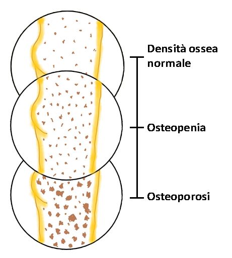 Differenza tra osteopenia ed osteoporosi