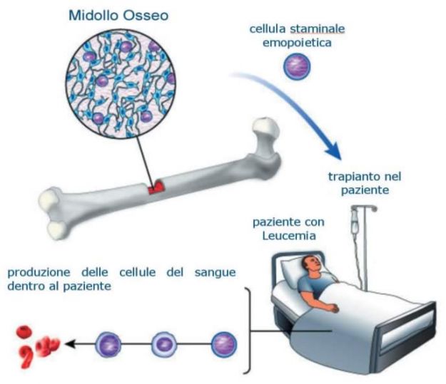 Trapianto di midollo osseo in un paziente con leucemia - donazione midollo osseo